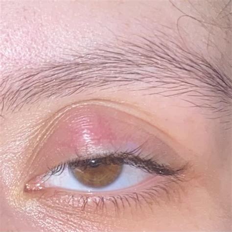 Itching Eyelids Rblepharitis