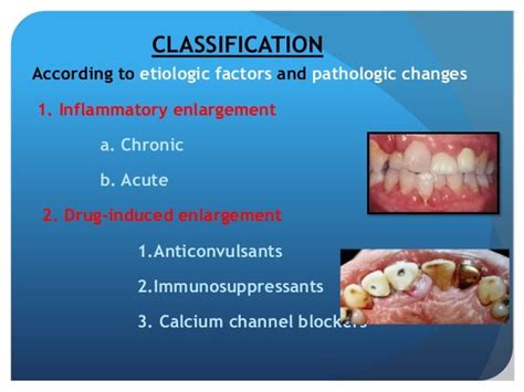 Gingival Enlargement