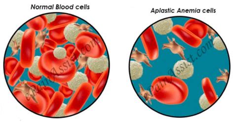 Group4presentation2 Aplasticanemia Wiki