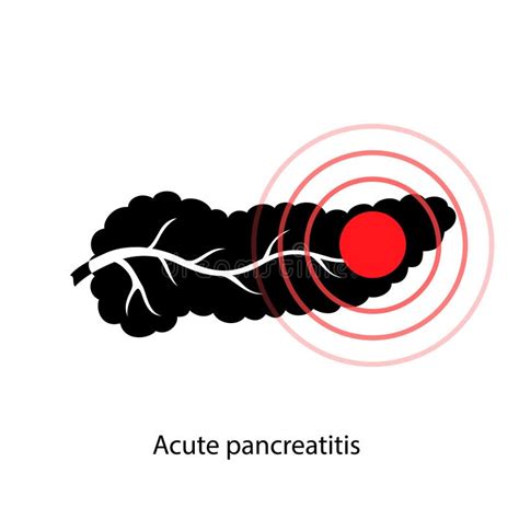 Acute Pancreatitis Stock Illustrations 117 Acute Pancreatitis Stock