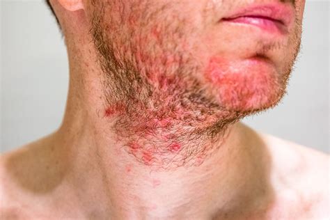 Beard Rash A Four Step Guide To Soothe And Prevent Future Breakouts Beard Club The Beard Club