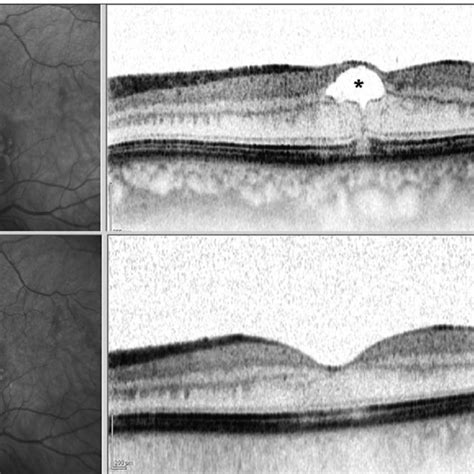 A Spectral Domain Optical Coherence Tomography Of The Left Eye Showing