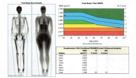 OsteoStrong Mobile | Hillcrest How to Read Your Dexa Scan Results
