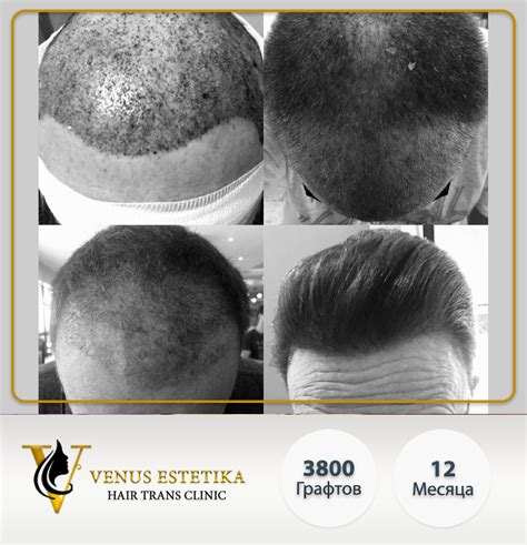 Фото до и после пересадки волос