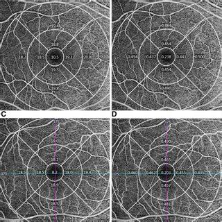 Optical Coherence Tomography Angiography Samples Of Hyperopia Ametropic