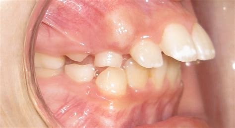 Overbite Teeth Treatment