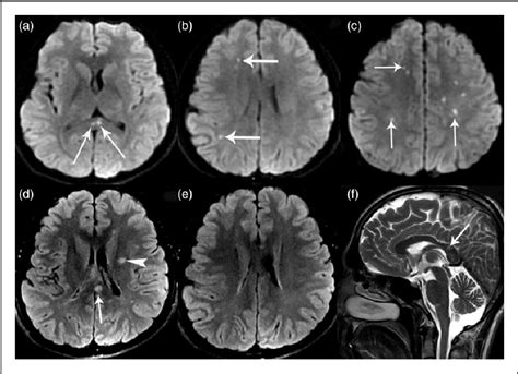 Figure From Susacs Syndrome As A Rare Arterial Stroke Mimic