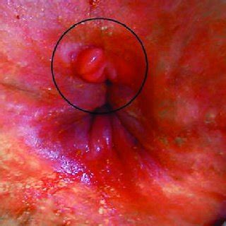 Fisura anal crónica cicatrizada Download Scientific Diagram