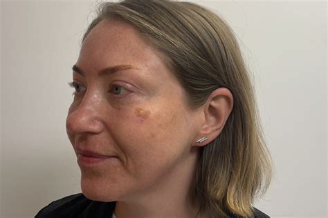 Solar Lentigo Brisbane Skin Dermatologist Brisbane Medical