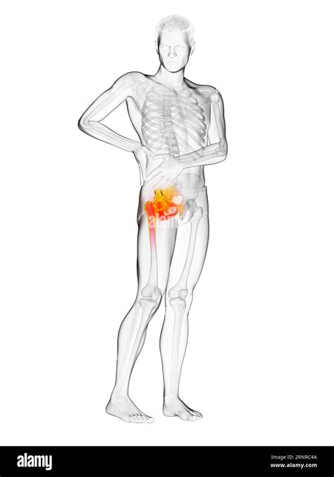 Man With A Painful Hip Joint Illustration Stock Photo Alamy