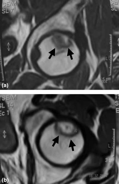 Magnetic Resonance Imaging Mri Of Grade Femoral Head Avascular