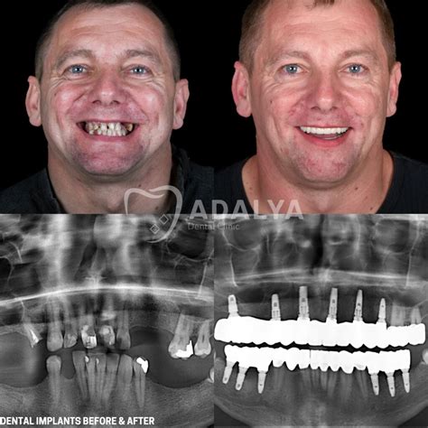 dental implants    pictures  guideline