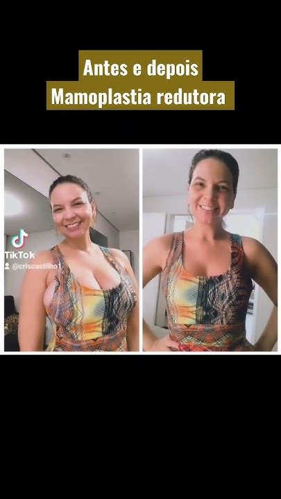 Mama Acessória Antes E Depois - Antes e depois redução de mamas. Mamoplastia redutora, resultado 3 ...