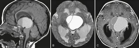 Sellar And Juxtasellar Tumors Radiology Key