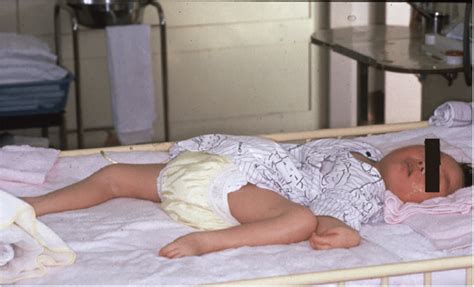 A 3 Year Old Patient With Menkes Disease He Is Bedridden And Suffers Download Scientific