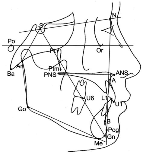 Cephalometric Tracing Of Linear Measurements Cephalometric Landmarks