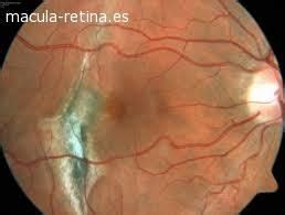 Qu Son Las Drusas Maculares Asociaci N M Cula Retina