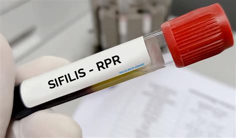 Sifilis Reagina Plasmática Rápida RPR precio de 20 soles