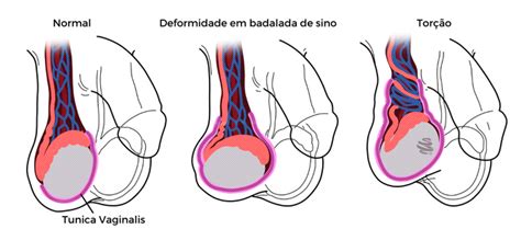 Torção Testicular Causas E Consequências - Torção Testicular: Procedimentos e Diagnóstico