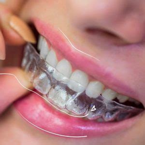 Retenedores Dentales Invisalign Precio Y Tipos2021 SMySecret