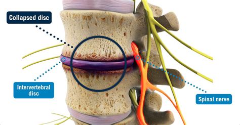 Collapsed Disc Usa Spine Care Laser Spine Surgery