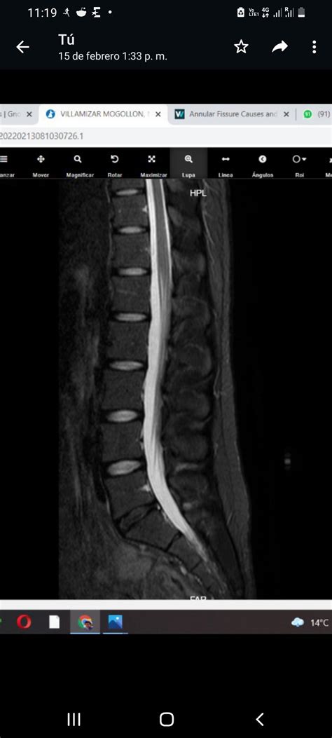 My Back Mri Rbackpain