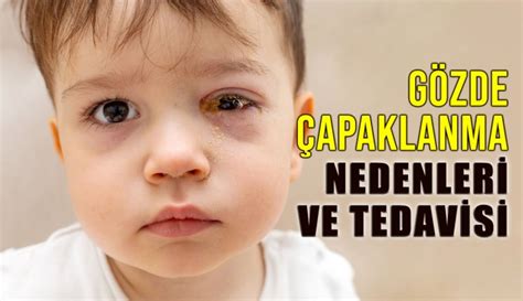 Göz Çapaklanması Nedenleri ve tedavisi