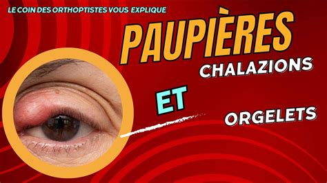 Comment Soigner Un Chalazion Un Orgelet Tu Risques D Tre Surpris