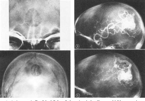 Figure From Hemangioma Of The Skull Associated With Intracranial