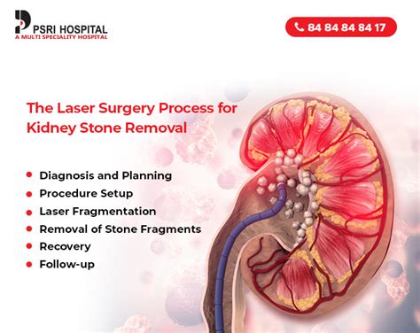 stent  kidney stone procedure