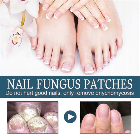 Nail Fungus Treatment for Toenails, Toenail Fungus Treatment, Extra