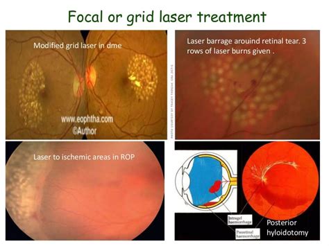 LASERS IN RETINA | PDF