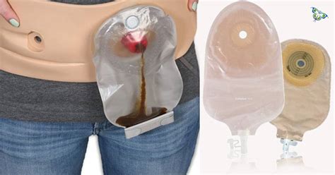 Vexed With The Smelly Urostomy Pouch Here Are Some Solutions