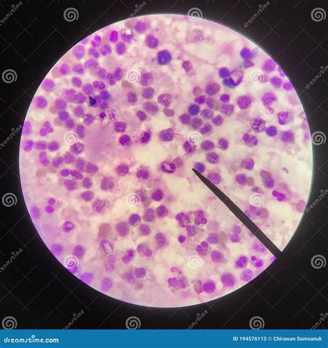 Abnormal Red Blood Cells In Blood Smear Thalassemia Patient Royalty