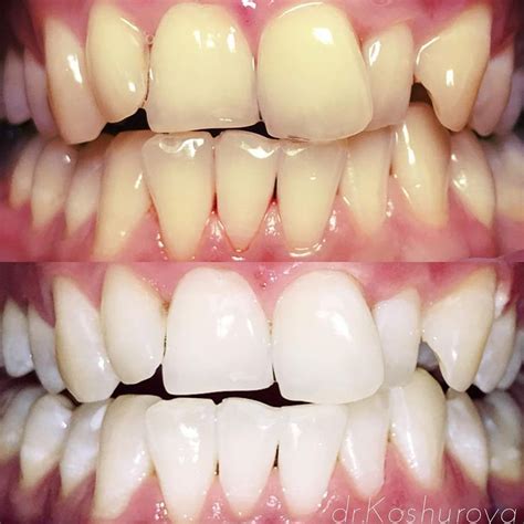 Пин на доске Отбеливание зубов