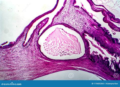 Ovarian Mucinous Cystadenoma Light Micrograph Stock Image Image Of