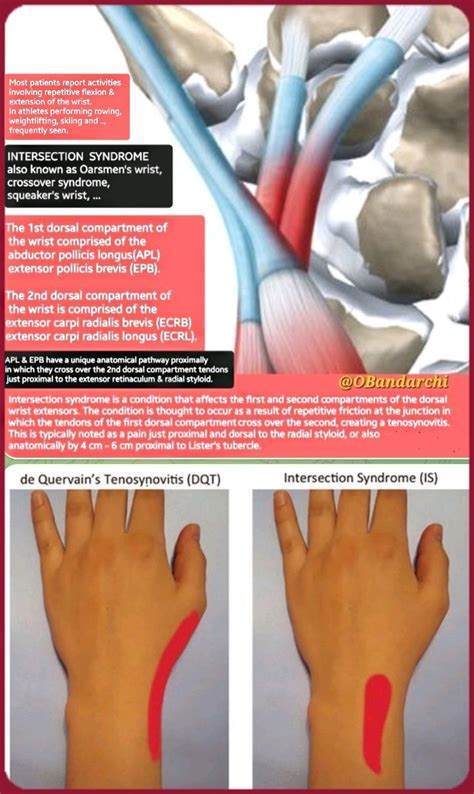 Dr Omid Bandarchi M D On Twitter 🛑intersection Syndrome🛑 Is An Inflammatory Tenosynovitis At