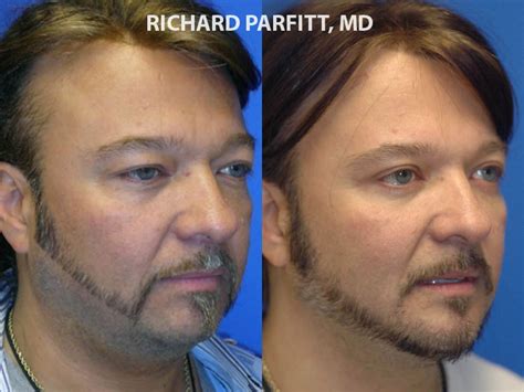 Chin Implant Photos Parfitt Facial Plastic Surgery Center