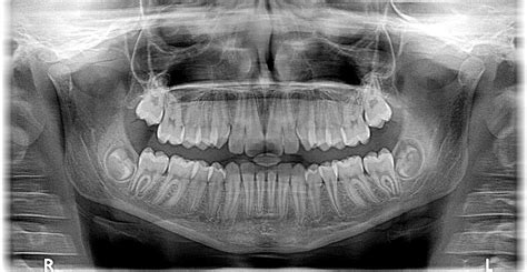 Tipos De Radiograf As Dentales En Ja N Cl Nica Dental Carvajal