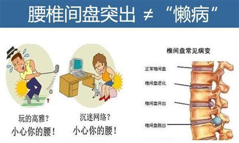 腰椎間盤突出比較好的自我治療的方法 每日頭條