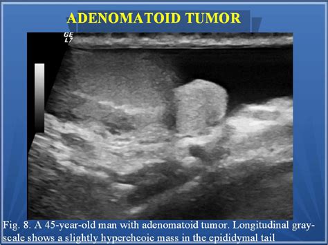 Epididymis Lump Ultrasound