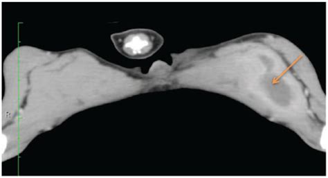 Metastatic Pulmonary Carcinomas In Cats Feline Lungdigit Syndrome