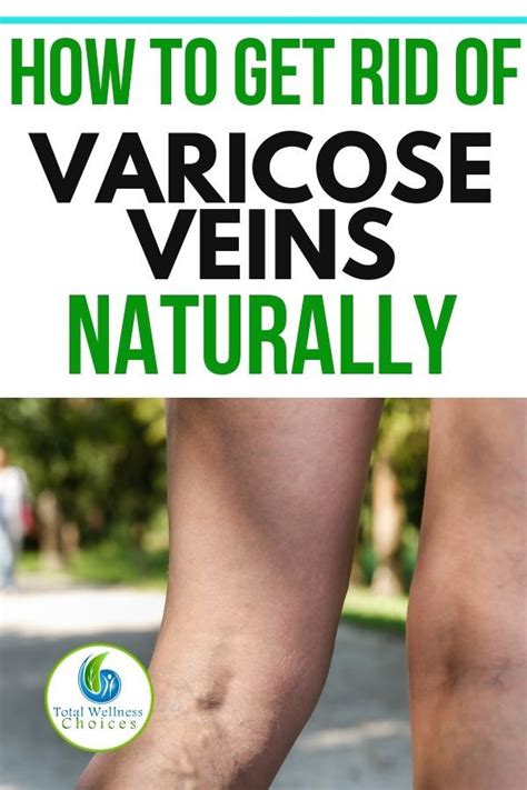 12 Natural Ways To Help Varicose Veins Varicose Veins Varicose