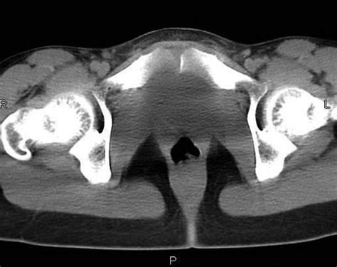 Computerized Tomography Scan Of The First Patient Showing Absence Of