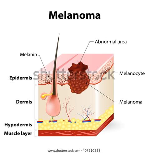 Melanoma Skin Cancer Layers Human Skin Stock Vector (Royalty Free ...