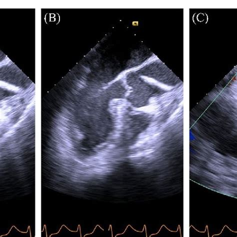 Intraoperative transesophageal echocardiography(TEE). A, B TEE images... | Download Scientific ...