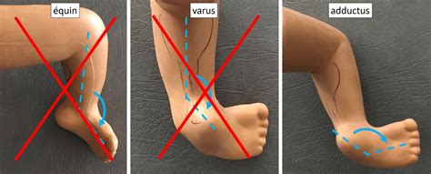 le metatarsus varus ou adductus orthopedie pediatriquecom