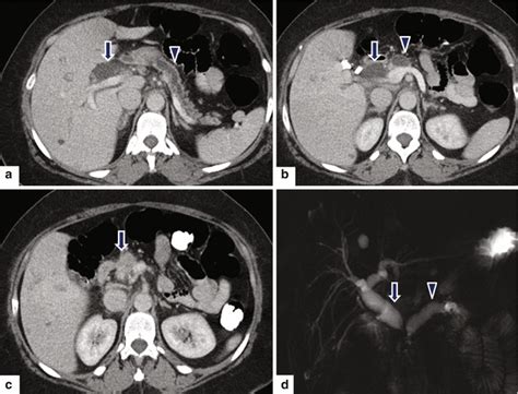 Pancreatic Ductal Adenocarcinoma Pdac Radiology Key