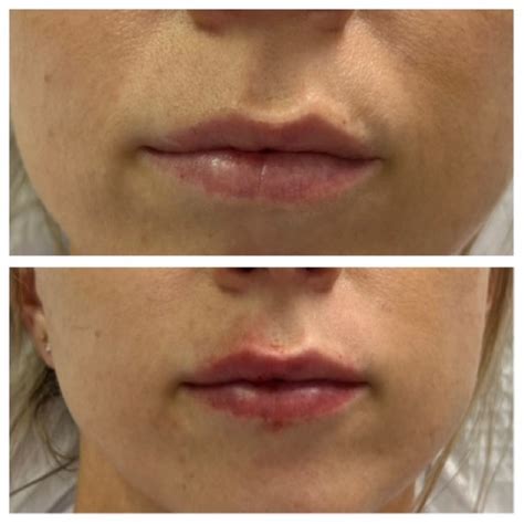 Dermal Fillers Revivify Medical Spa Contact Us Today