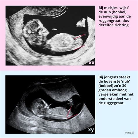 Baby Gender Prediction Ultrasound Boy Or Girl 12 Week Ultrasound